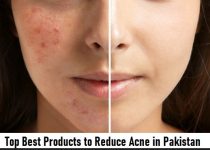 Top Best Products to Reduce Acne in Pakistan